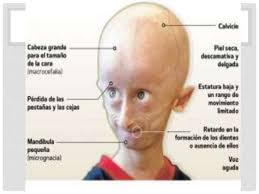 Caratteristiche progeria